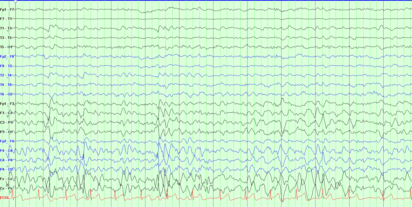 EEG waveform recording demonstrating vertex waves.